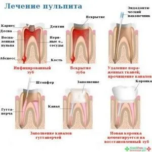 Чому зуб болить тільки вночі (чому) Чому зуб болить тільки вночі