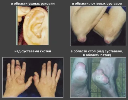 Подагра (подагричний артрит) причини, симптоми, лікування (подагричний) Подагра (подагричний артрит) причини, симптоми, лікування