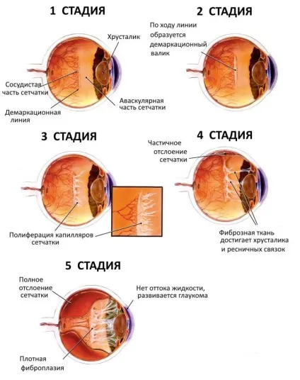 Ретинопатія недоношених дітей стадії і ступеня, причини, симптоми, діагностика та лікування, (ретинопатія) Ретинопатія недоношених дітей стадії і ступеня, причини, симптоми, діагностика та лікування,