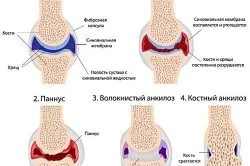 Серонегативний ревматоїдний артрит що це таке і його лікування (здоровий скелет) Серонегативний ревматоїдний артрит що це таке і його лікування