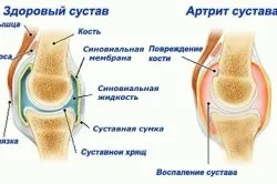 Серонегативний ревматоїдний артрит що це таке і його лікування (таке) Серонегативний ревматоїдний артрит що це таке і його лікування