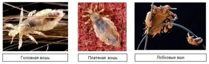 Секретний рецепт виведення вошей і гнид з допомогою оцту поради дерматовенеролога (вошей) Секретний рецепт виведення вошей і гнид з допомогою оцту поради дерматовенеролога