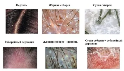 Лущиться шкіра на голові у дорослого, секрети краси і здоров'я жінки (шкіра) Лущиться шкіра на голові у дорослого, секрети краси і здоров'я жінки