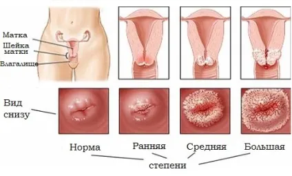 Симптоми лейкоплакії шийки матки і методи лікування патології (матки) Симптоми лейкоплакії шийки матки і методи лікування патології