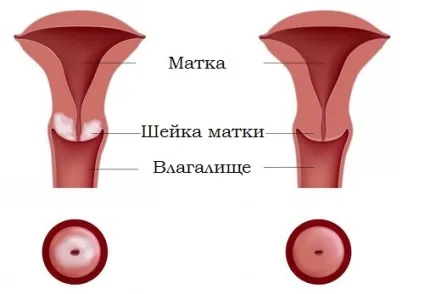 Симптоми лейкоплакії шийки матки і методи лікування патології (матки) Симптоми лейкоплакії шийки матки і методи лікування патології