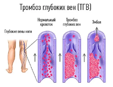 Тромбоз глибоких вен