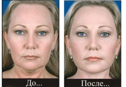 Ультразвукова підтяжка обличчя (відгуки, ціни) (ультразвуковий ліфтинг особи) Ультразвукова підтяжка обличчя (відгуки, ціни)
