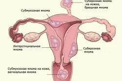 Фіброміома і міома в чому різниця (фіброміома) Фіброміома і міома в чому різниця