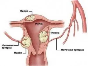Фіброміома і міома в чому різниця, способи лікування (лікування) Фіброміома і міома в чому різниця, способи лікування