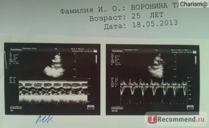 Ехокардіографія (УЗД серця)