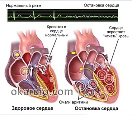 Раптова коронарна смерть (ВКС) причини, симптоми, перша допомога та прогноз (раптова) Раптова коронарна смерть (ВКС) причини, симптоми, перша допомога та прогноз