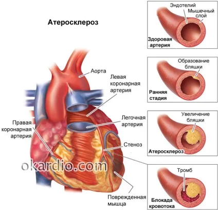 Раптова коронарна смерть (ВКС) причини, симптоми, перша допомога та прогноз (причини) Раптова коронарна смерть (ВКС) причини, симптоми, перша допомога та прогноз