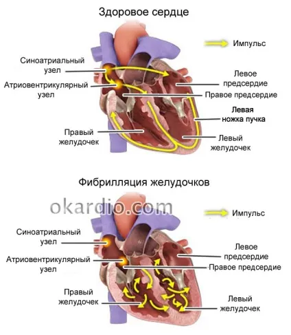 Раптова коронарна смерть (ВКС) причини, симптоми, перша допомога та прогноз (смерть) Раптова коронарна смерть (ВКС) причини, симптоми, перша допомога та прогноз
