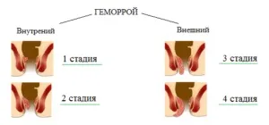 Хронічний геморой причини, симптоми і лікування (симптоми) Хронічний геморой причини, симптоми і лікування
