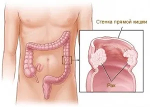 Відновлення кишечника після операції 1 (операції) Відновлення кишечника після операції 1