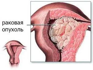 Аденокарцинома ендометрію (матки) - симптоми, прогноз і лікування (матки) Аденокарцинома ендометрію (матки) - симптоми, прогноз і лікування