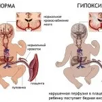 Антенатальна асфіксія плода (внутрішньоутробна, интранатальная) (антенатальна) Антенатальна асфіксія плода (внутрішньоутробна, интранатальная)