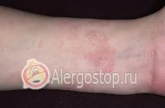 Алергія на годинник - алергія у дорослих (алергія) Алергія на годинник - алергія у дорослих