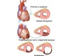 Аневризма міжпередсердної перегородки у дітей, чи небезпечно це, чи потрібно лікувати (дітей) Аневризма міжпередсердної перегородки у дітей, чи небезпечно це, чи потрібно лікувати