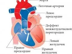 Аневризма міжпередсердної перегородки у дітей, чи небезпечно це, чи потрібно лікувати (Аневризма міжпередсердної перегородки) Аневризма міжпередсердної перегородки у дітей, чи небезпечно це, чи потрібно лікувати