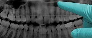 Alpha dent implants - зубні імплантати