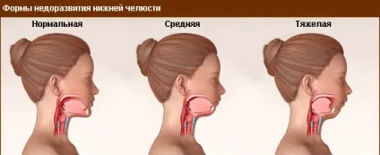 Аномалії розвитку щелепи і причини недорозвинення (розвитку) Аномалії розвитку щелепи і причини недорозвинення