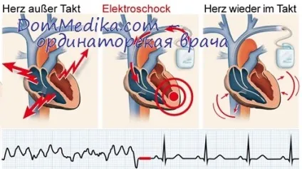 Аневризма міокарда після інфаркту - лікування серця (лікування) Аневризма міокарда після інфаркту - лікування серця
