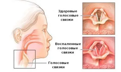 Алергічний ларингіт у дитини і дорослих, симптоми, лікування (дорослих) Алергічний ларингіт у дитини і дорослих, симптоми, лікування
