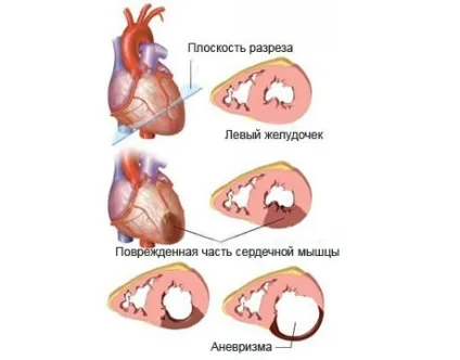 Аневризма міжпередсердної перегородки у дітей, чи небезпечно це, чи потрібно лікувати (перегородки) Аневризма міжпередсердної перегородки у дітей, чи небезпечно це, чи потрібно лікувати