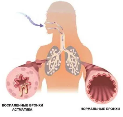 Алергічний ларингіт у дитини і дорослих, симптоми, лікування (лікування) Алергічний ларингіт у дитини і дорослих, симптоми, лікування