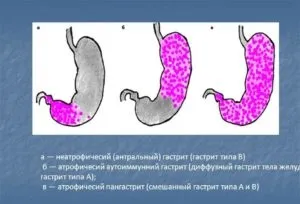 Антральний поверхневий гастрит що це таке (гастрит) Антральний поверхневий гастрит що це таке