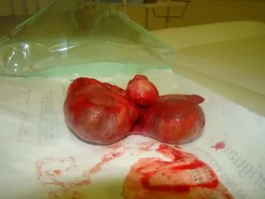 Атерома за вухом як лікувати
