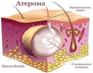 Атерома - лікування без операції в домашніх умовах, як зняти запалення (лікування) Атерома - лікування без операції в домашніх умовах, як зняти запалення
