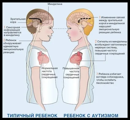 атиповий аутизм