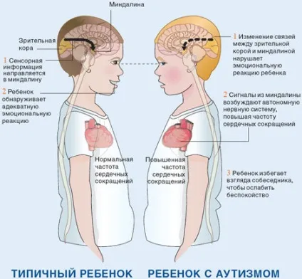 Аутизм або ранній дитячий аутизм (давайте розбиратися (ранній) Аутизм або ранній дитячий аутизм (давайте розбиратися