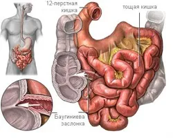 Баугін - клінічна картина, діагностика і лікування (клінічна) Баугін - клінічна картина, діагностика і лікування
