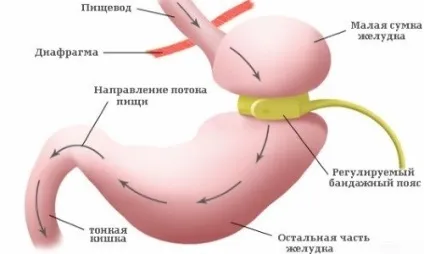 Бандажування шлунка особливості операції, показання (фото і відео) (шлунка) Бандажування шлунка особливості операції, показання (фото і відео)