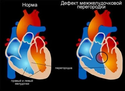 Гіпертрофія лівого шлуночка серця причини, симптоми