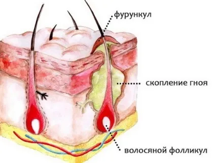 Фурункул на шиї або чиряк на шиї