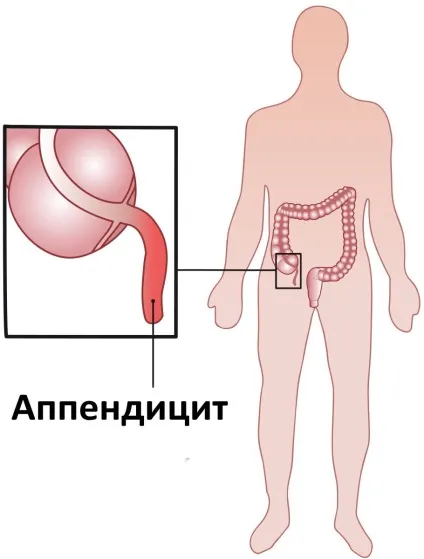 Гангренозний апендицит причини, симптоми і лікування (симптоми) Гангренозний апендицит причини, симптоми і лікування