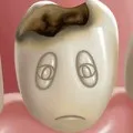 Фіссурний карієс причини, лікування, діагностика (карієс) Фіссурний карієс причини, лікування, діагностика