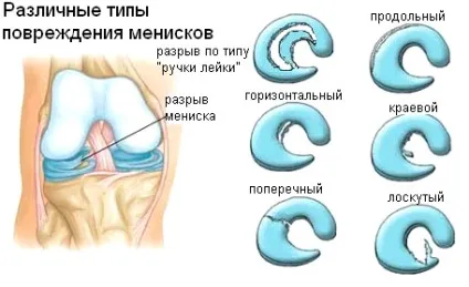 Біль під коліном ззаду до якого лікаря звернутися, причини та методи лікування (якому) Біль під коліном ззаду до якого лікаря звернутися, причини та методи лікування