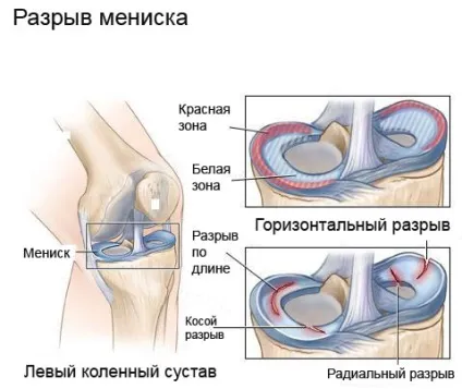 Біль під коліном ззаду до якого лікаря звернутися, причини та методи лікування (патології) Біль під коліном ззаду до якого лікаря звернутися, причини та методи лікування