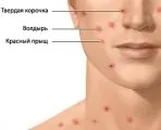 Сверблять прищі на животі причини, фото (прищі на тілі) Сверблять прищі на животі причини, фото