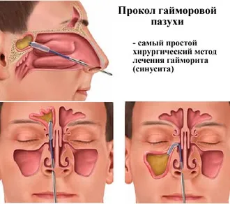 Що робити, якщо болять пазухи носа - кращі методи лікування (болять) Що робити, якщо болять пазухи носа - кращі методи лікування
