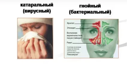 Що робити, якщо болять пазухи носа - кращі методи лікування (болять) Що робити, якщо болять пазухи носа - кращі методи лікування