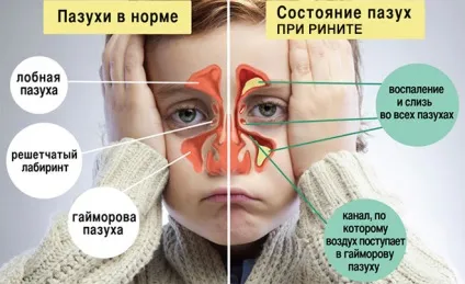 Що робити, якщо у дитини не проходить нежить (дитини) Що робити, якщо у дитини не проходить нежить
