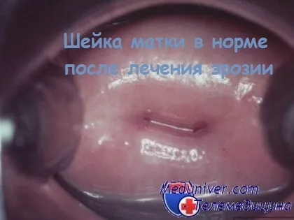 Що означає діагноз ерозія шийки матки лікування ерозії шийки матки (шийки) Що означає діагноз ерозія шийки матки лікування ерозії шийки матки