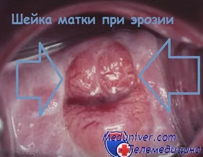 Що означає діагноз ерозія шийки матки лікування ерозії шийки матки (матки) Що означає діагноз ерозія шийки матки лікування ерозії шийки матки