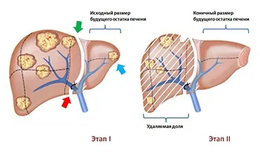 Що таке операція alpps в чому її переваги і недоліки (майбутнього залишку печінки) Що таке операція alpps в чому її переваги і недоліки